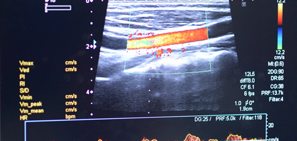 What Is A Carotid Intima Media Thickness Test Quality Mobile Ultrasound